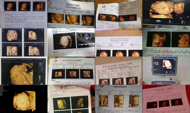 汕头6个月四维彩超