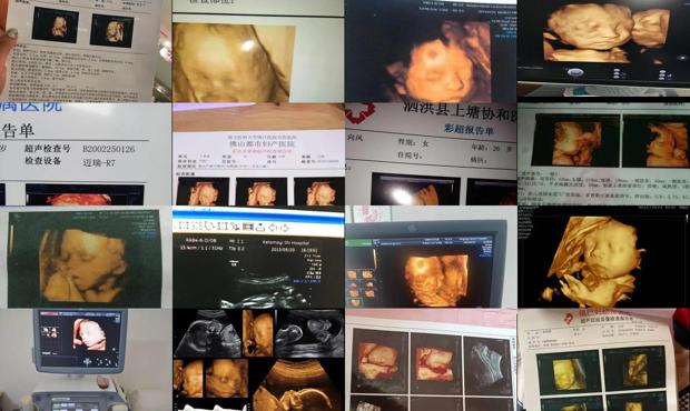 汕头5个月四维彩超
