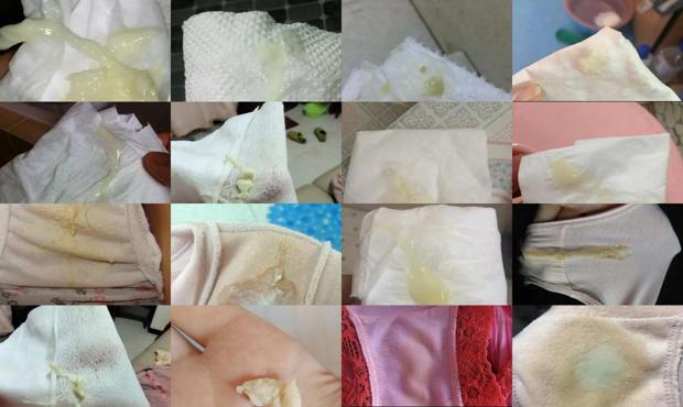 汕头豆腐渣白带