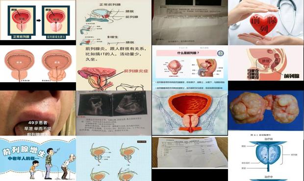 汕头前列腺增大是什么意思