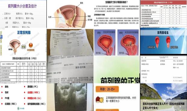 汕头前列腺大小的正常标准是多少