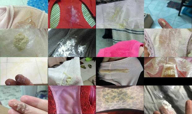 汕头白带异常豆腐渣且瘙痒