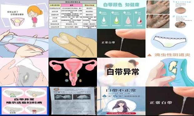 汕头白带颜色发黄图片