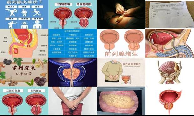 汕头前列腺早期症状
