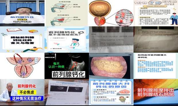 汕头前列腺增大并伴有钙化是什么意思