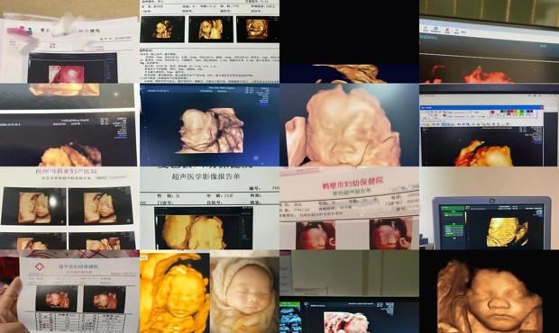 汕头孕妇六个月四维彩超