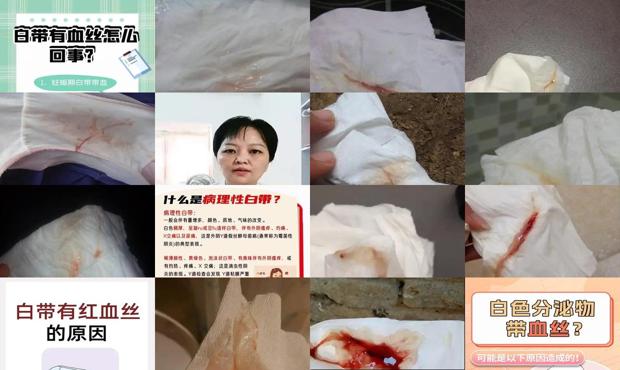 汕头为什么白带有点血丝
