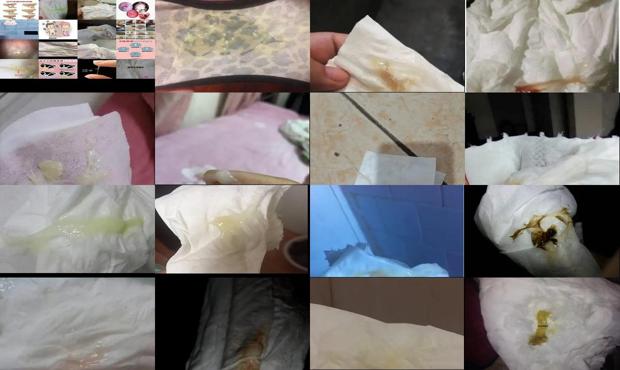 脓血性分泌物图片 - 汕头脓血性白带